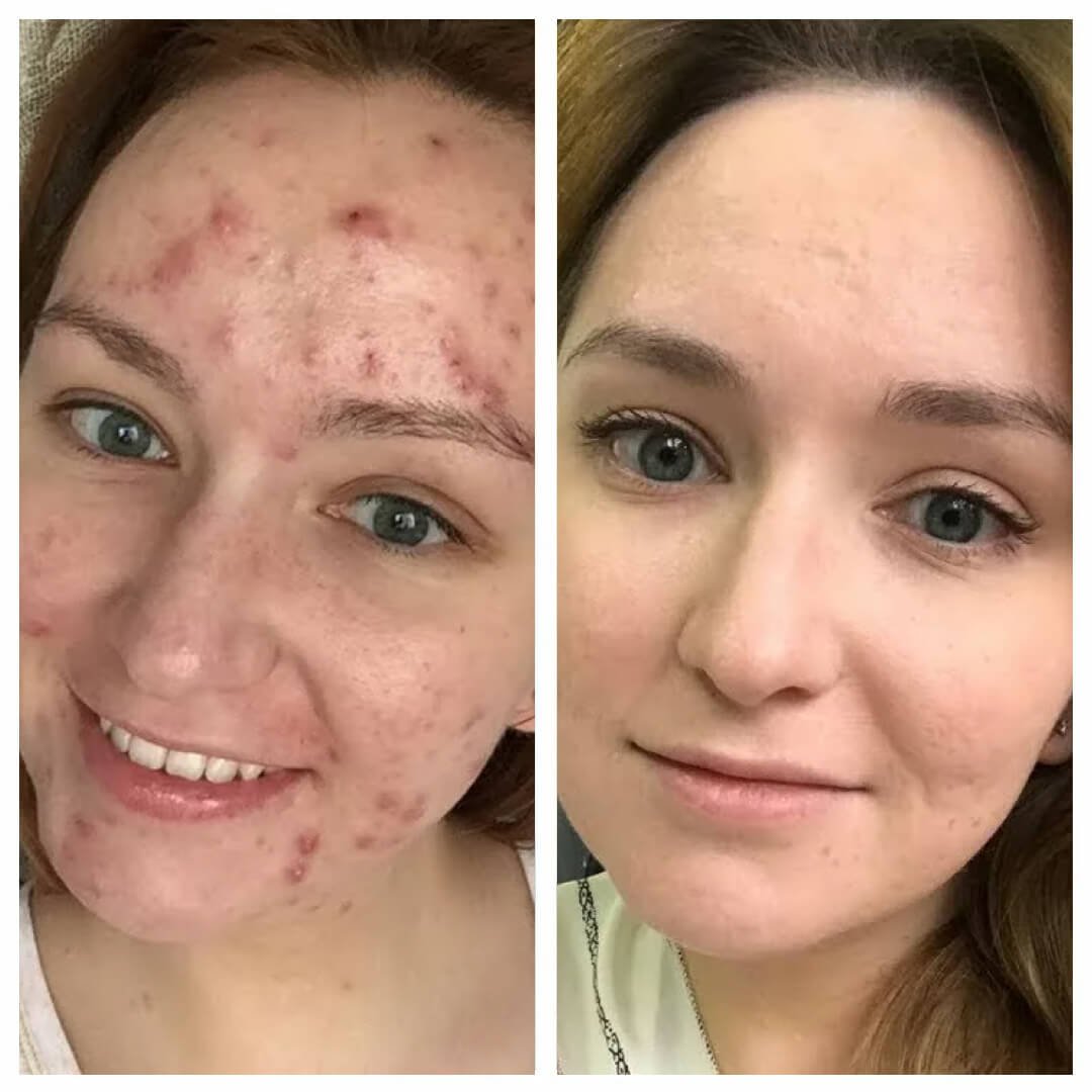 Acne before after