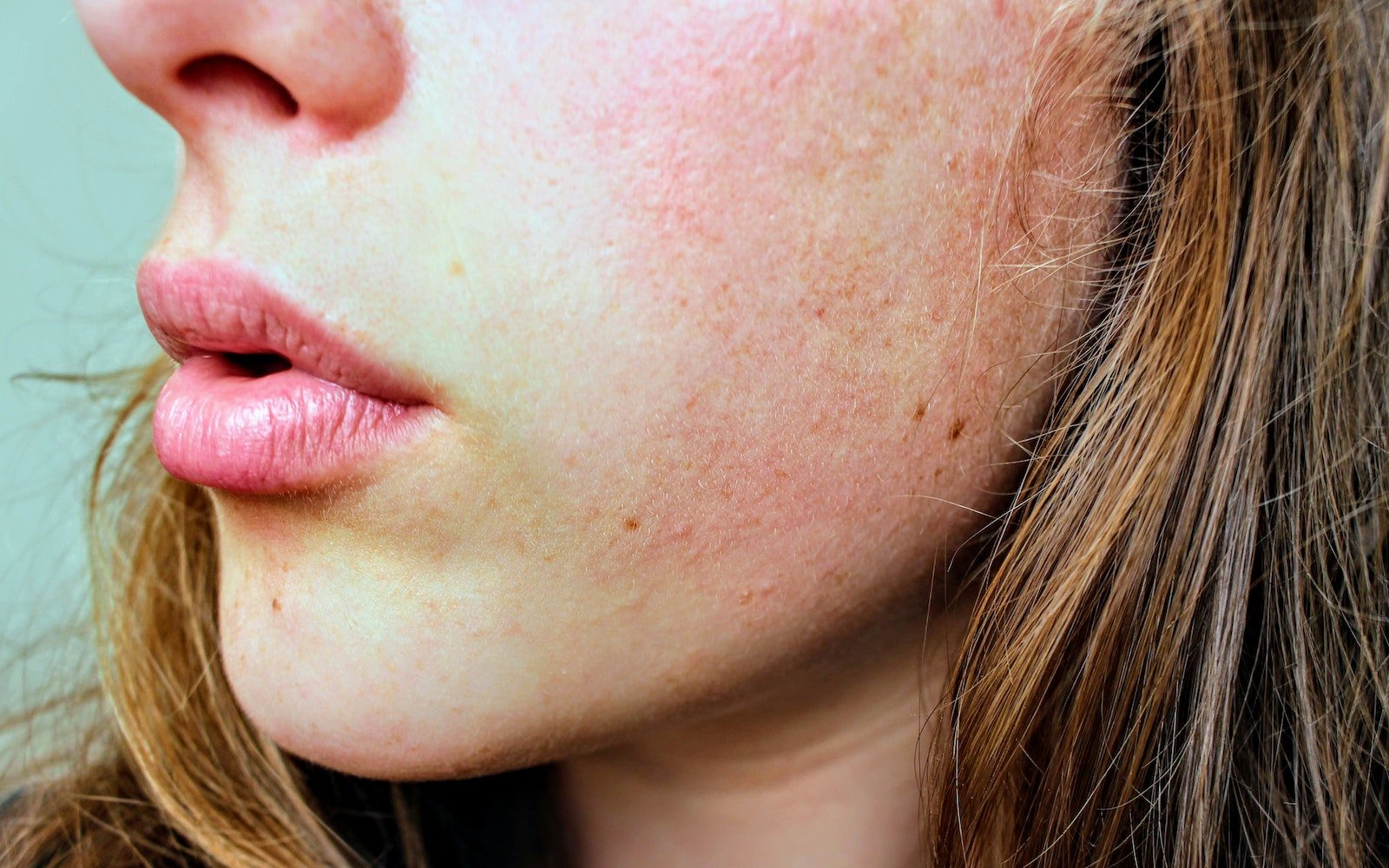 Close up of broken skin barrier on woman's face